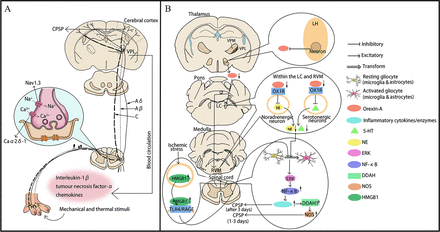 Central post-stroke pain: advances in clinical and preclinical